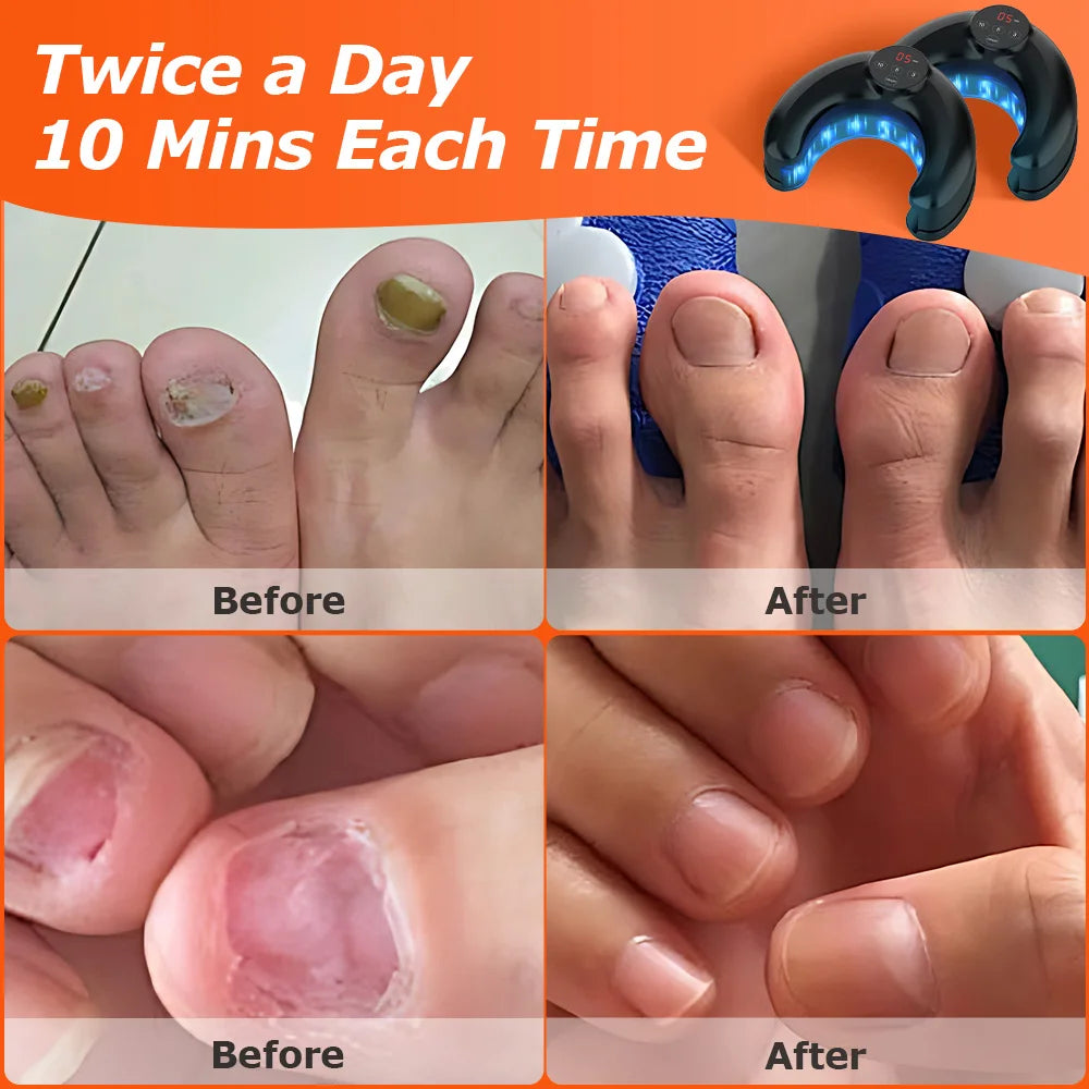 45W Nail Fungus Treatment LED Laser Device for Multiple Toenails USB Charge Infrared Light and Blue Light Nail Care